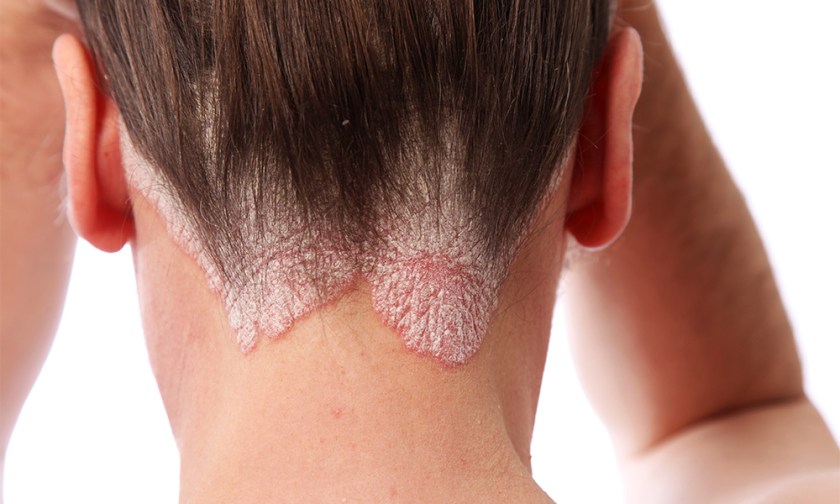 Take The Sting Out of Psoriasis