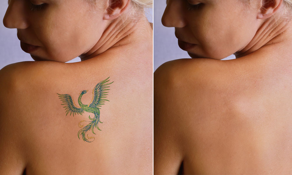 Tattoo Removal: Top Tips For a Clean Slate - SPA+CLINIC
