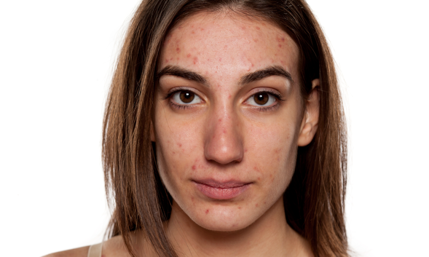 Is Over-Treating Skin Causing Adult Acne Epidemic?