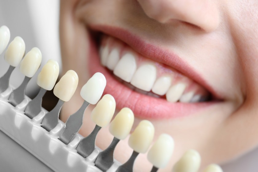 4 Reasons To Get On The Teeth Whitening Trend