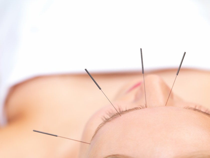 Is Cosmetic Acupuncture The New Micro Needling?