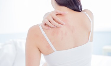 eczema support