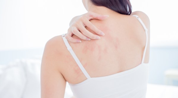 eczema support