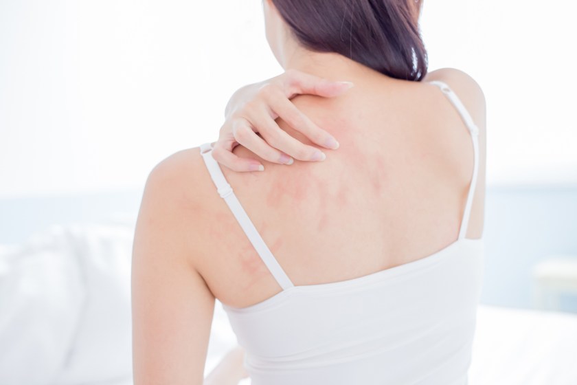 How To Support Your Clients With Eczema