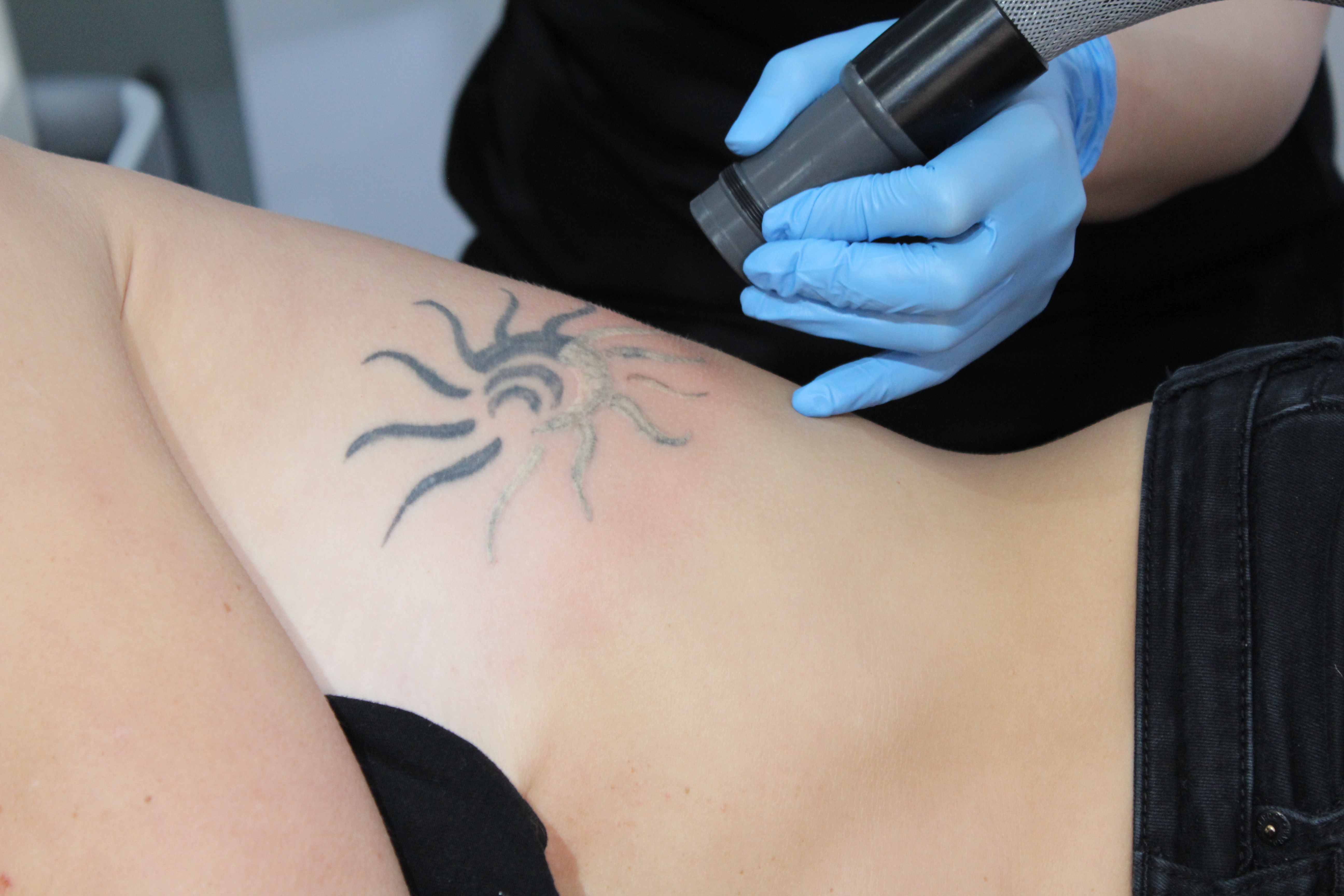 What You Should Know About Laser Tattoo Removal Side Effects
