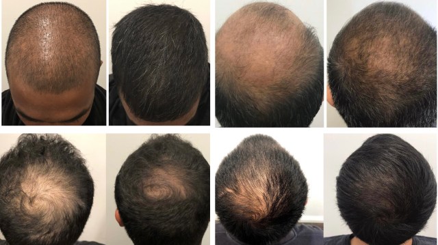 Hair And Skin Science Is Bringing Its PRP and PRF Treatments To WA