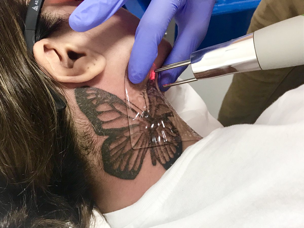 Describe PFD Patch Tattoo Removal  rTattooRemoval
