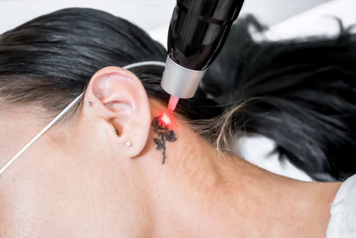 How The US Is Leading The Innovation In Tattoo Removal