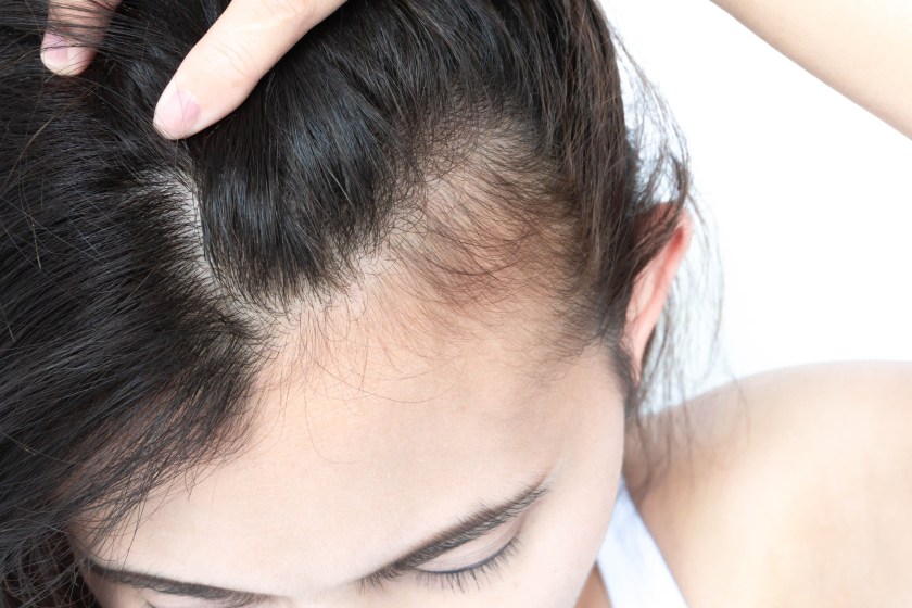 The Rise Of Filler-Induced Alopecia
