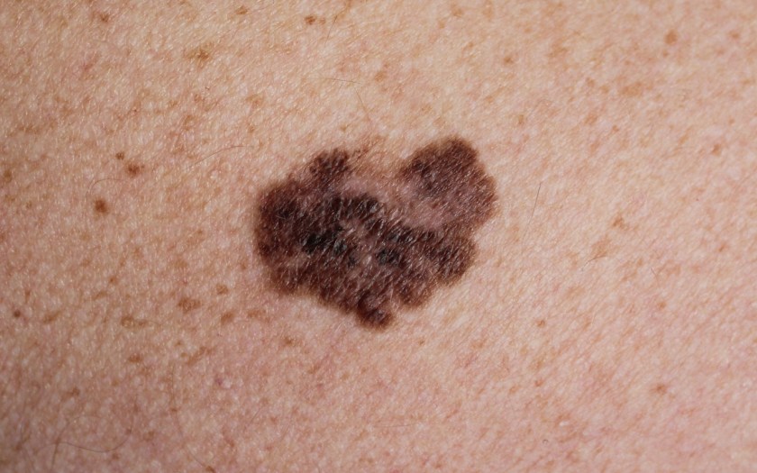 We Are One Step Closer To A Skin Cancer Vaccine
