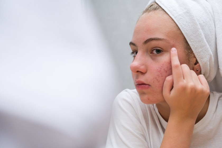 The Do’s And Don’t’s For Treating Patients On Acne Medication