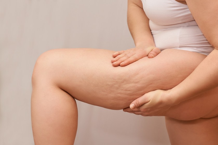 Here’s What Practitioners Need To Know About Lipoedema