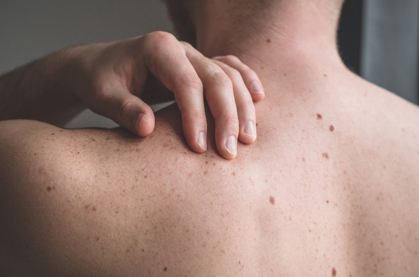An mRNA Vaccine For Preventing Melanoma Could Be Here In 2025